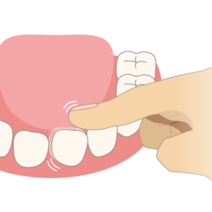 Zahnunfall, lockerer Zahn — Schliefer & Engel | Zahnmedizin aus Waldfeucht-Haaren mit Herz
